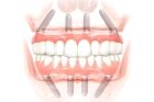 Коронка на имплант жевательного зуба