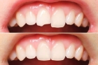 Восстановление зуба (полное)