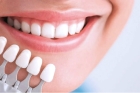 Эстетическая реставрация зубов 