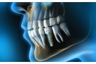 Имплант жевательного зуба