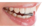 Имплант зуба с коронкой цирконий