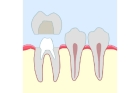 Культевая вкладка на многокорневой зуб 