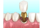 Культевая вкладка на однокорневой зуб
