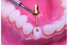 Культевая вкладка на многокорневой зуб (разборная)