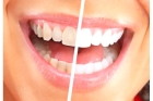 Экспресс-отбеливание зубов