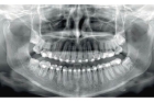 Компьютерная томография зуба
