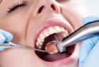 Лечение кариеса депульпированного зуба