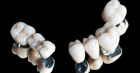 Коронка зуба металлокерамическая