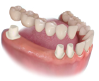 Мостовидное протезирование зубов