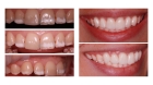 Частичная реставрация зуба 