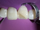 Реставрация скола зуба 