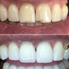 Реставрация поверхности зуба 