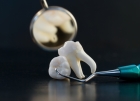 Удаление зубов простое