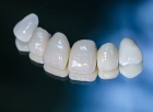 Металлокерамическая коронка на зуб 