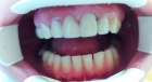 Зубной мост 5 зубов 