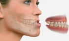 Исправление прикуса зубов