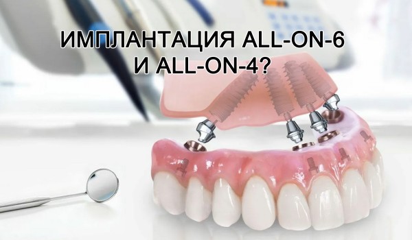Что такое имплантация All-on-6 и All-on-4?