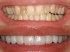 Эстетическая реставрация зубов  